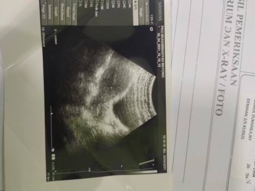 Pendarahan, test pack positif, Hasil USG penebalan dinding rahim