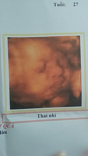 Trâu vàng của mẹ 37w5d, đủ ngày đủ tháng mạnh khỏe ra với ba mẹ con nhé 😘