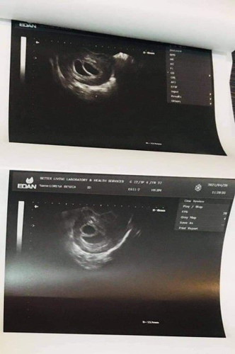 8 weeks Gestational Sac