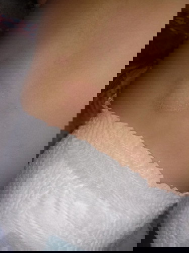 ลูกเป็นแบบนี้ข้างหลังค่ะต้องใช้ยาอะไรให้หายค่ะ