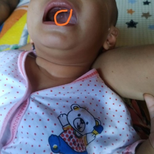 Benjolan putih di langit mulut anak