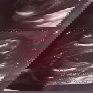 ช่วยดูให้หน่อยค่ะน้องเป็น  ผู้หญิง รึ ผู้ชาย หมอบอกว่า ผู้หญิง มีแต่คนทักว่า ผู้ชาย  20สัปดาห์ แล้ว