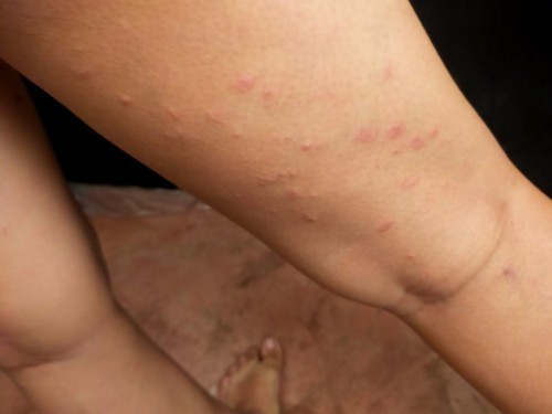 Good morning mommies. Ask ko Lang Kung Sino nagka rashes while pregnant. Super itchy b/w my thigh
