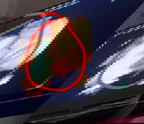 Bayi terlilit tali pusar