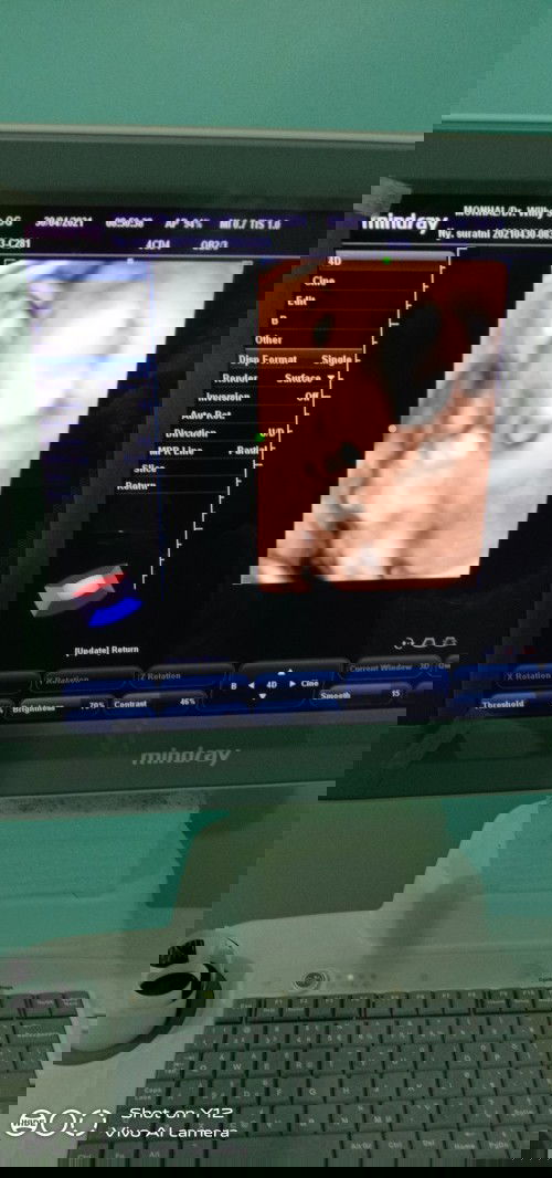 Air ketuban sedikit, apa solusinya ya?