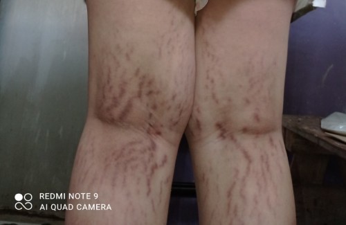 Varicose Veins? Stretch marks?