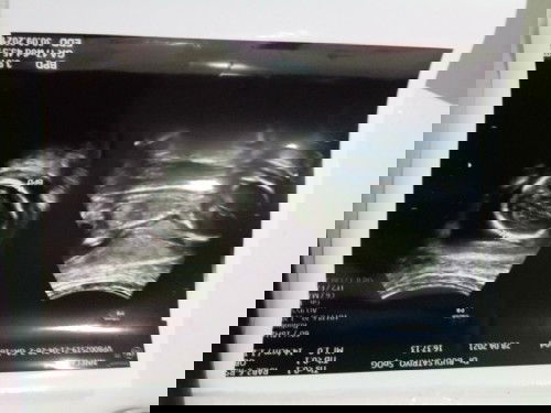 Berapakah normal lingkar kepala usia janin 18week..