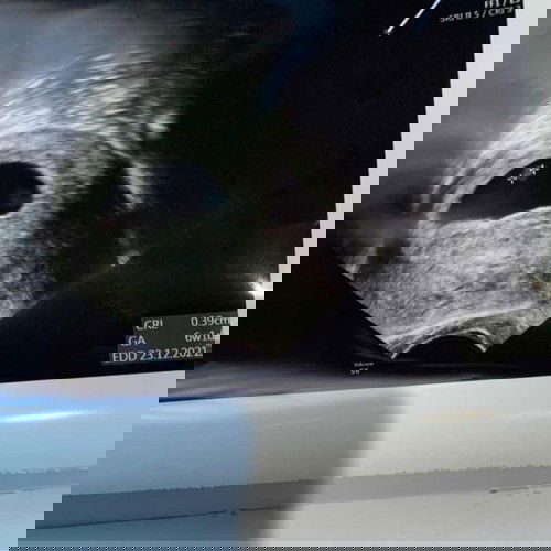 Perbedaan usia kehamilan