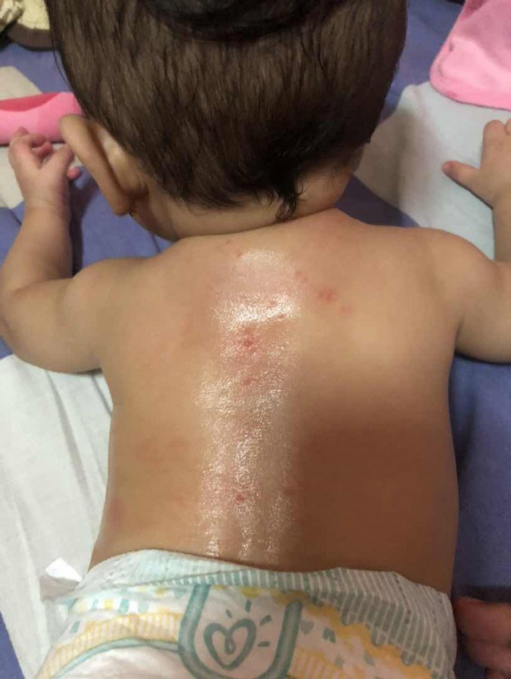 Rashes or insect bite?