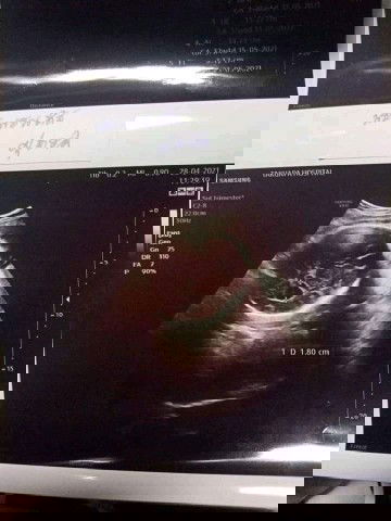 สอบถามค่ะ
ไปอัลตร้าซาวตอน36w.หมอบอกว่าเด็กมีน้ำในโพรงสมองลูกมากกว่าปกติ
จะเป็นอันตราหรือไม่ค่ะ😰