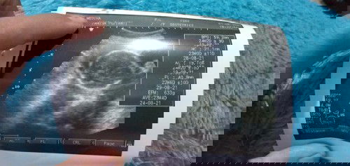 Posisi bayi nyungsang