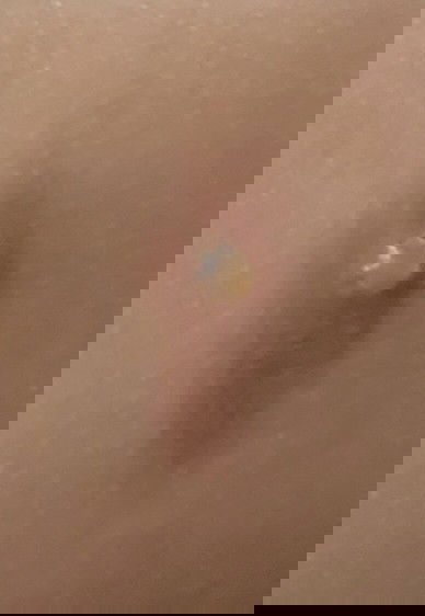 ตุ่มพุพองน้ำใสๆ