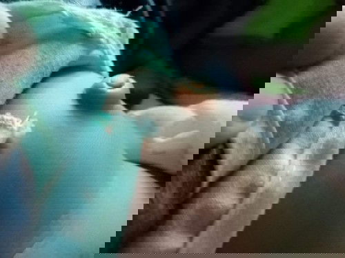 สะดือ​ปูดออกมาเยอะแบบนี้ปกติไหมครับ