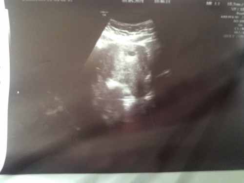 พึ่งตรวจเจอตอนประจำเดือนขาดไป5วันคะหมอบอกว่ามีถุงตั้งครรภ์อีก2อาทิตย์หมอนัดตรวจอีกรอบ