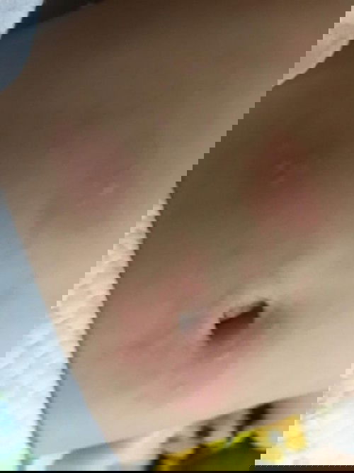 Rashes on baby skin