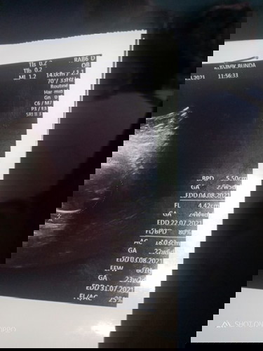 Cara baca tentang USG