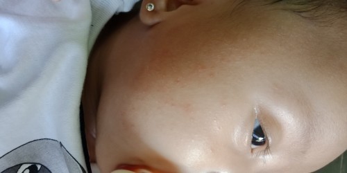 Bun  mau tanya klau seperti ini apakah alergi susu atau bruntusan biasa ya? Cara nguranginnya gmn?