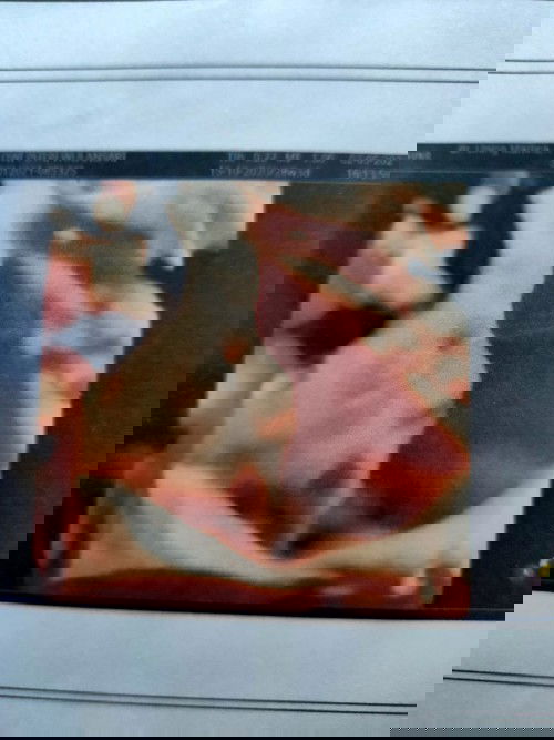 Placenta Previa Totalis