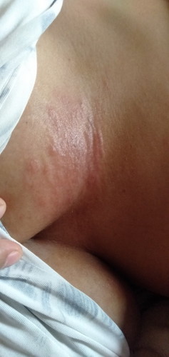 ผืนแดงขึ้นได้ราวนม แม่คันมากๆๆค่ะใครรุ้วิธีบรรเทาบางค่ะข่วยบอกแม่ที(แม่ทำนมมาค่ะ)