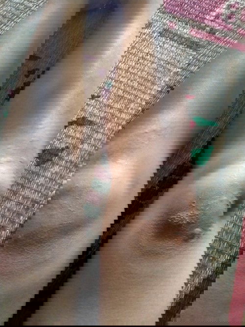 em bầu 14w mà em bị nổi mày đay như này có sao k ạ?