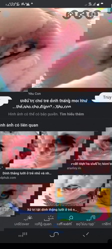 Bé mình 8 tháng mà bị dính thắng môi trên,như vậy có sao k mọi người,vậy là chậm nói pk ạ,..........