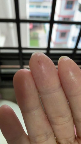 Skin finger issue