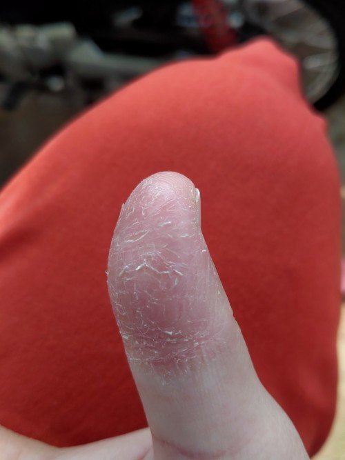 Jari tangan pecah2 gatal dan perih