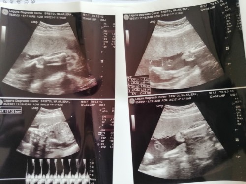 2nd time ultrasound 😭
