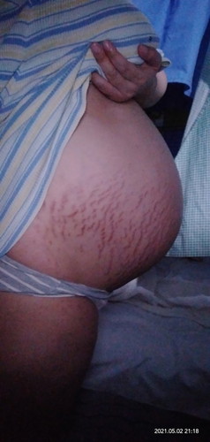 Stretch Marks