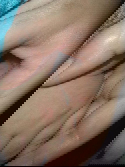 Insect  bite or what?