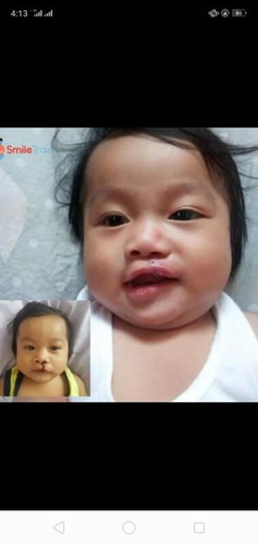 Cleft Lip Warrior