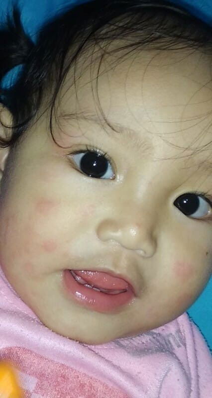 Bentol" seluruh badan hilang sendiri kambuh lagi