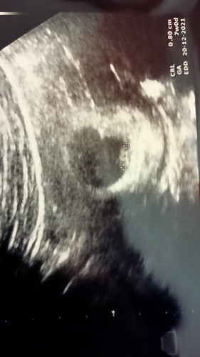 ถุงตั้งครรภ์ไม่กลมอันตรายมั้ยคะ