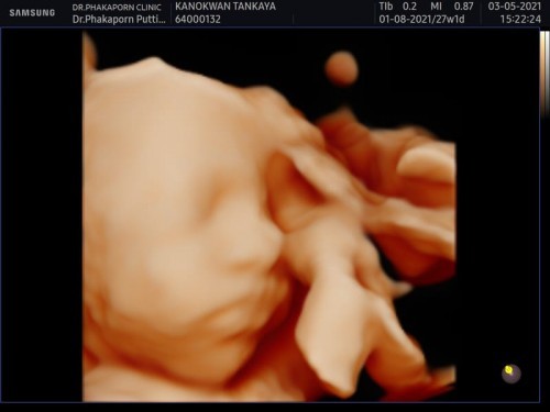 การคลอดธรรมชาติ