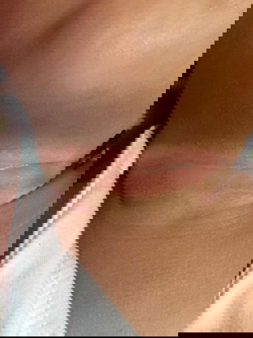 Rashes sa leeg ni baby