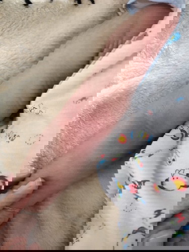 ลูกบ้านไหนแพ้โปรตีนนมวัวบ้างคะ มาแชร์ประสบการณ์ให้บ้านนี้หน่อย ดูแลลูกน้อยอย่างไรถึงหายคะ