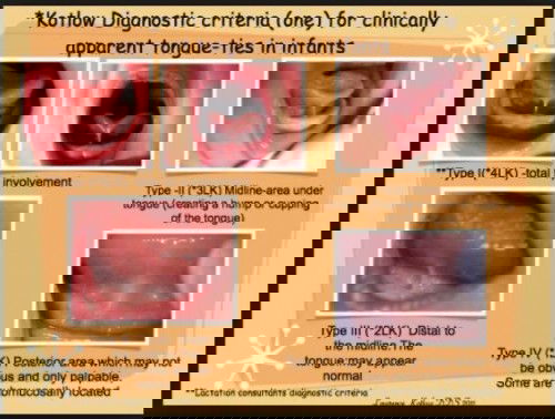 Tongue tie & lip tie