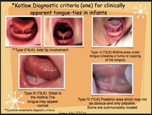 Tongue tie & lip tie
