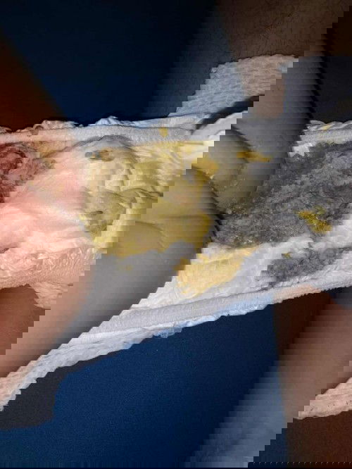 ขอปรึกษาว่าน้องแพ้นมหรือเปล่า