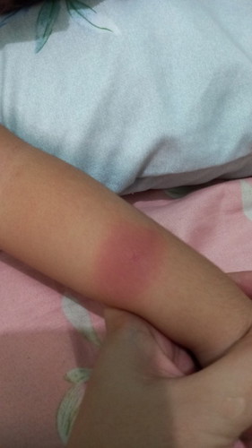 Insect bites
