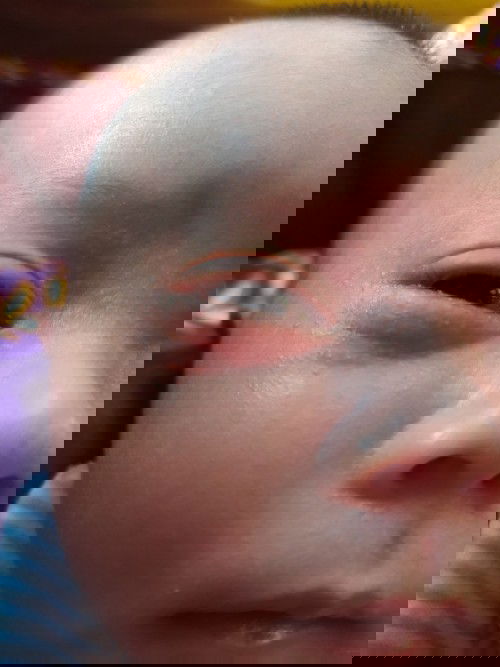 anak saya sakit mata