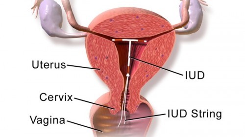 IUD- is it safe?