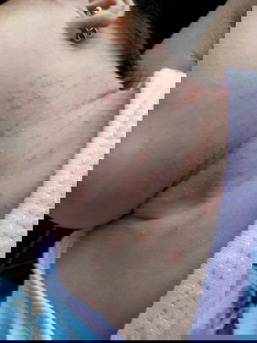 Skin Rashes