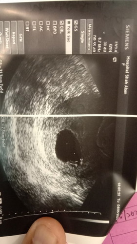 2 minggu lg dokter suruh cuci..sbb dh 11 minggu 3 hari nmpk kantung ja..😭😭