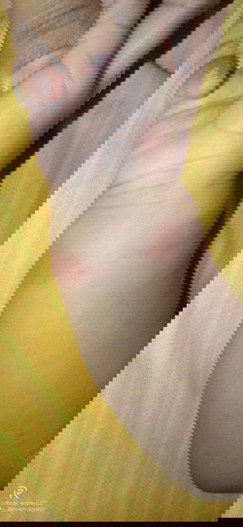 Solusi gatal² pada bayi