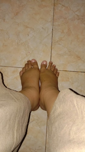 Kaki Bengkak
