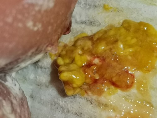 blood streaks sa newborn poops