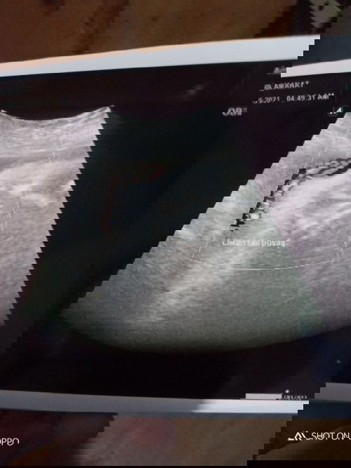 Bayiki terlilit Tali Pusar di 37w6h