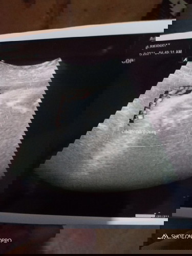 Bayiki terlilit Tali Pusar di 37w6h