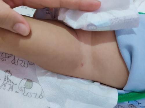 BCG vaccine